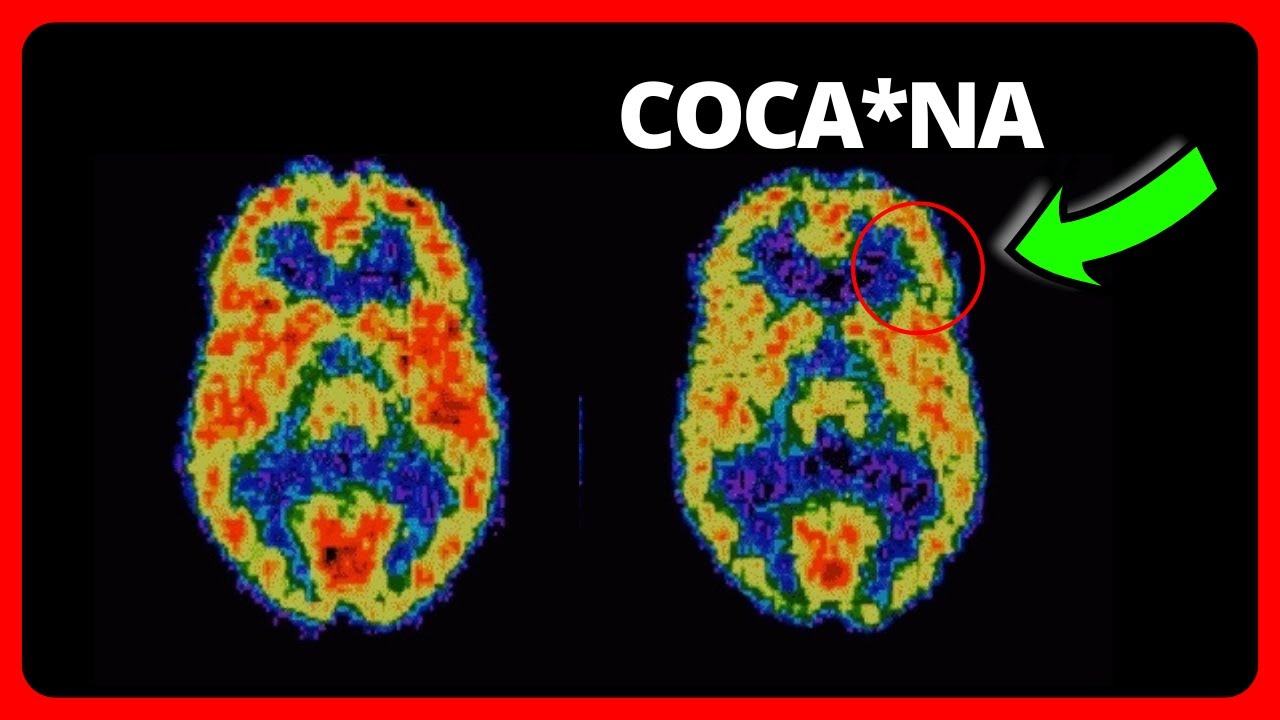 cuanto dura los sintomas de abstinencia