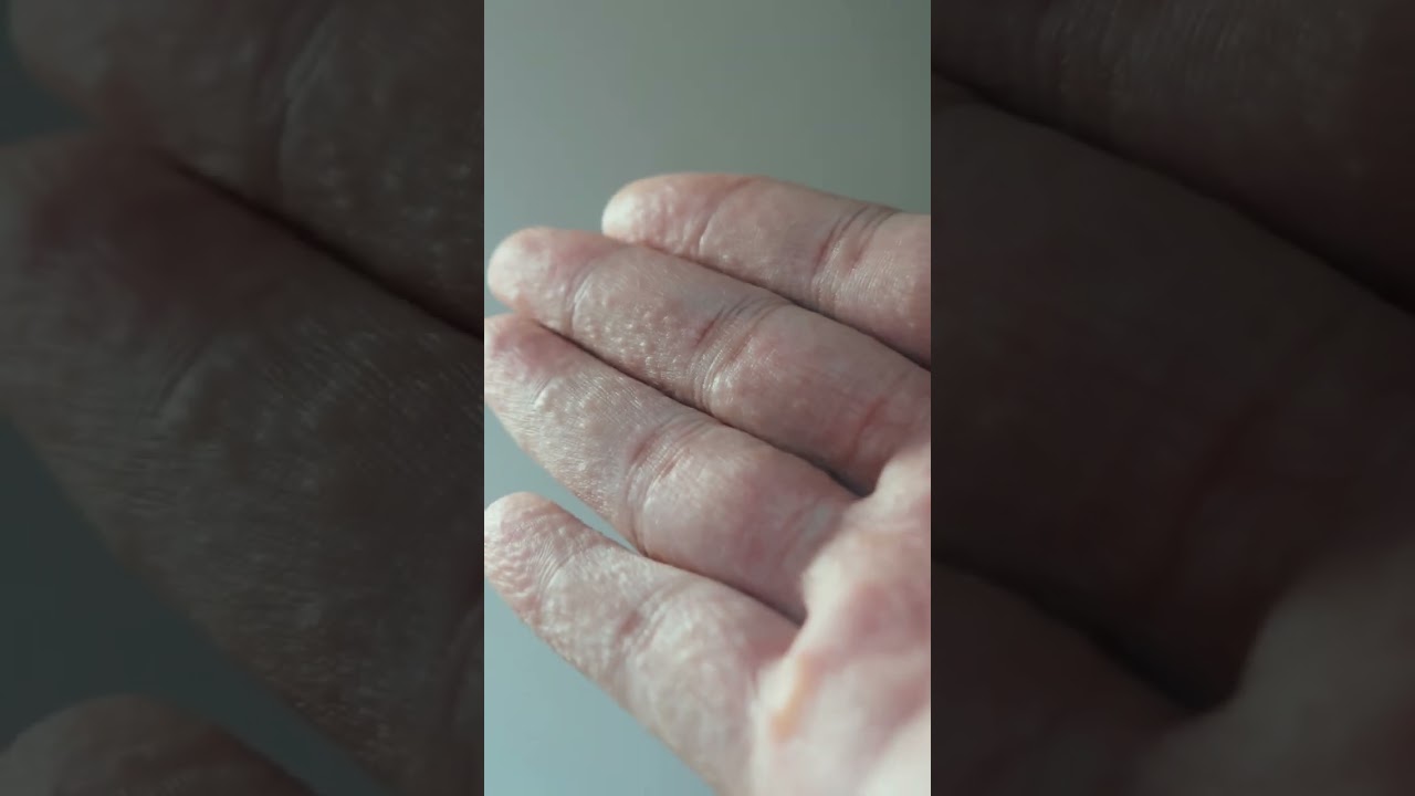 granitos en las manos por estres