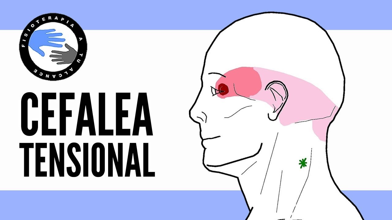 por qué se produce la cefalea tensional