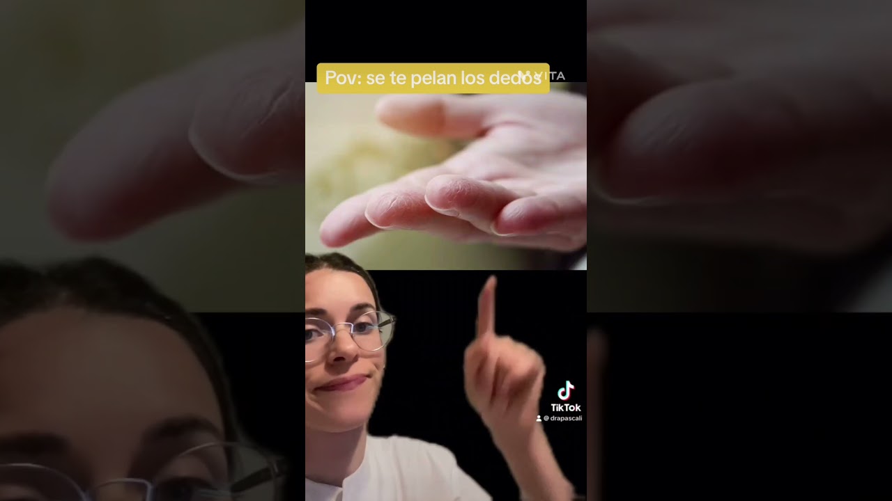 se pelan las manos por estrés